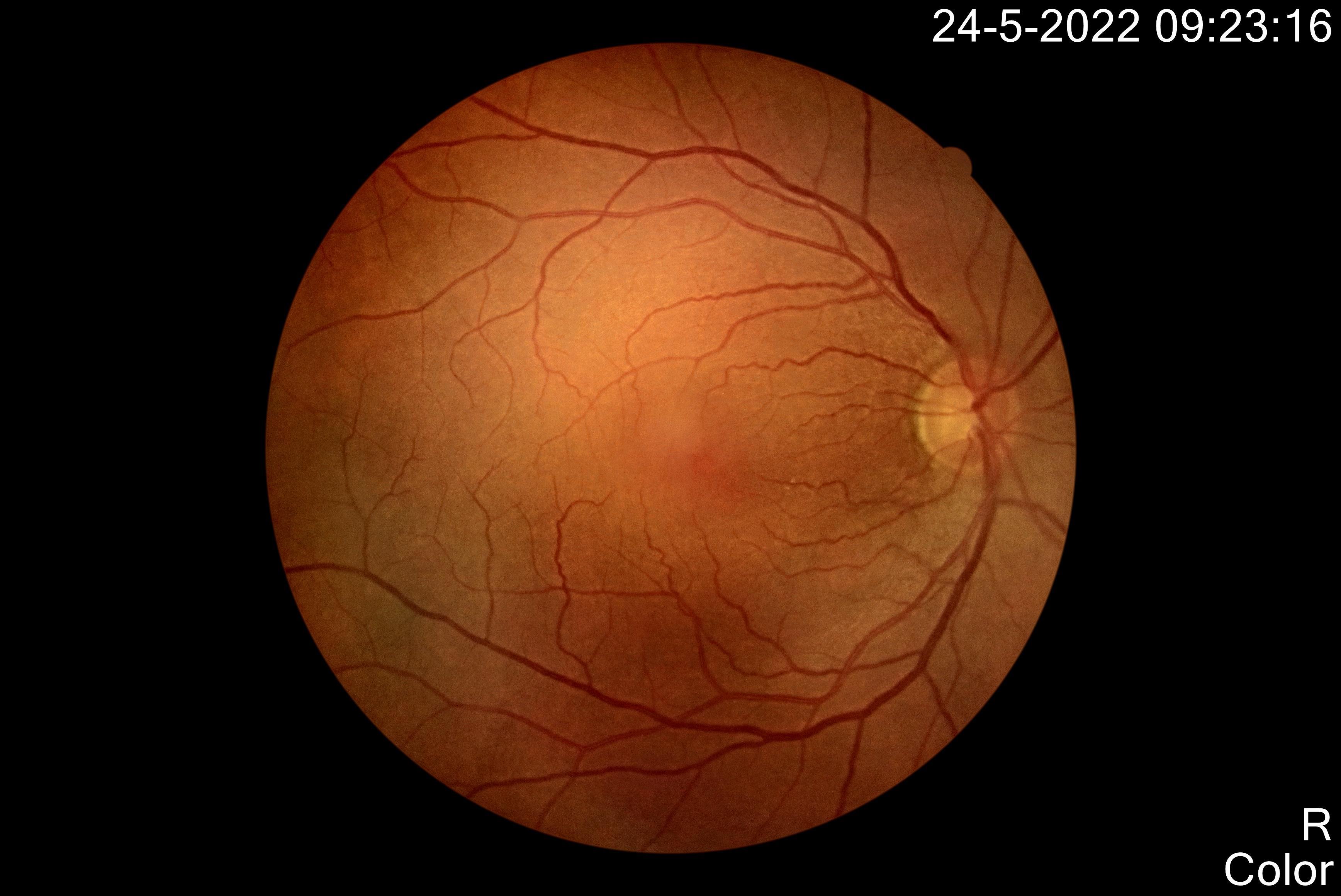 RETINASCAN IN VENLO